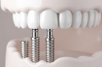 Имплантация зубов: как вернуть улыбку и забыть о протезах